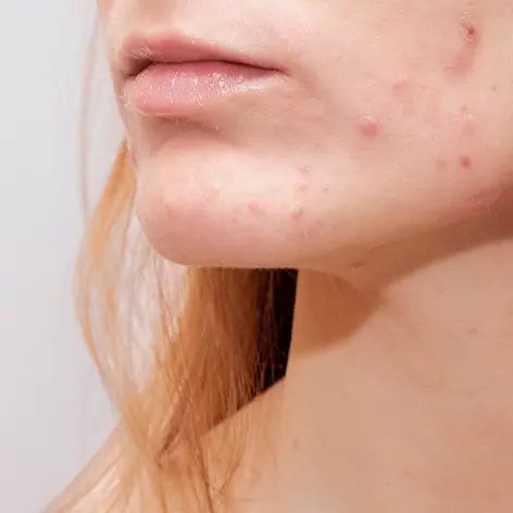 Dermatologue Maroc traitant un patient pour l'acné dans une clinique dermatologique"
