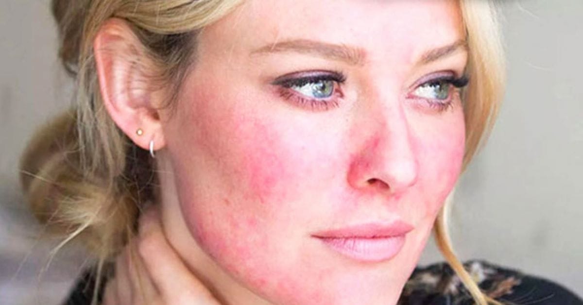 Image montrant des symptômes de l'acné rosacée, avec des rougeurs et des boutons sur le visage, conseillant la consultation d'un Dermatologue Maroc pour un traitement adapté.
