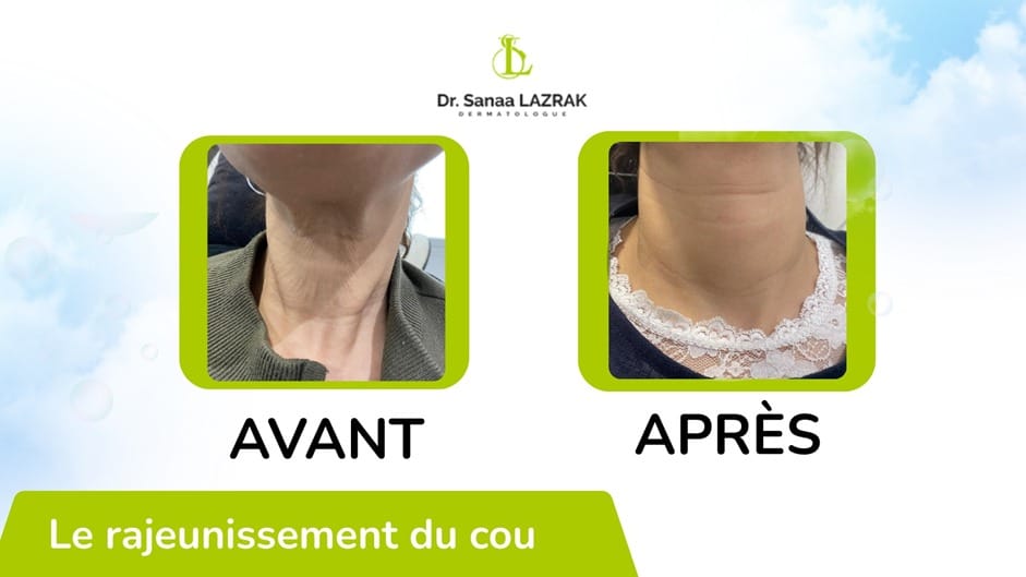 Dermatologue au Maroc réalisant un traitement esthétique du cou pour raffermir la peau et atténuer les signes de l’âge.